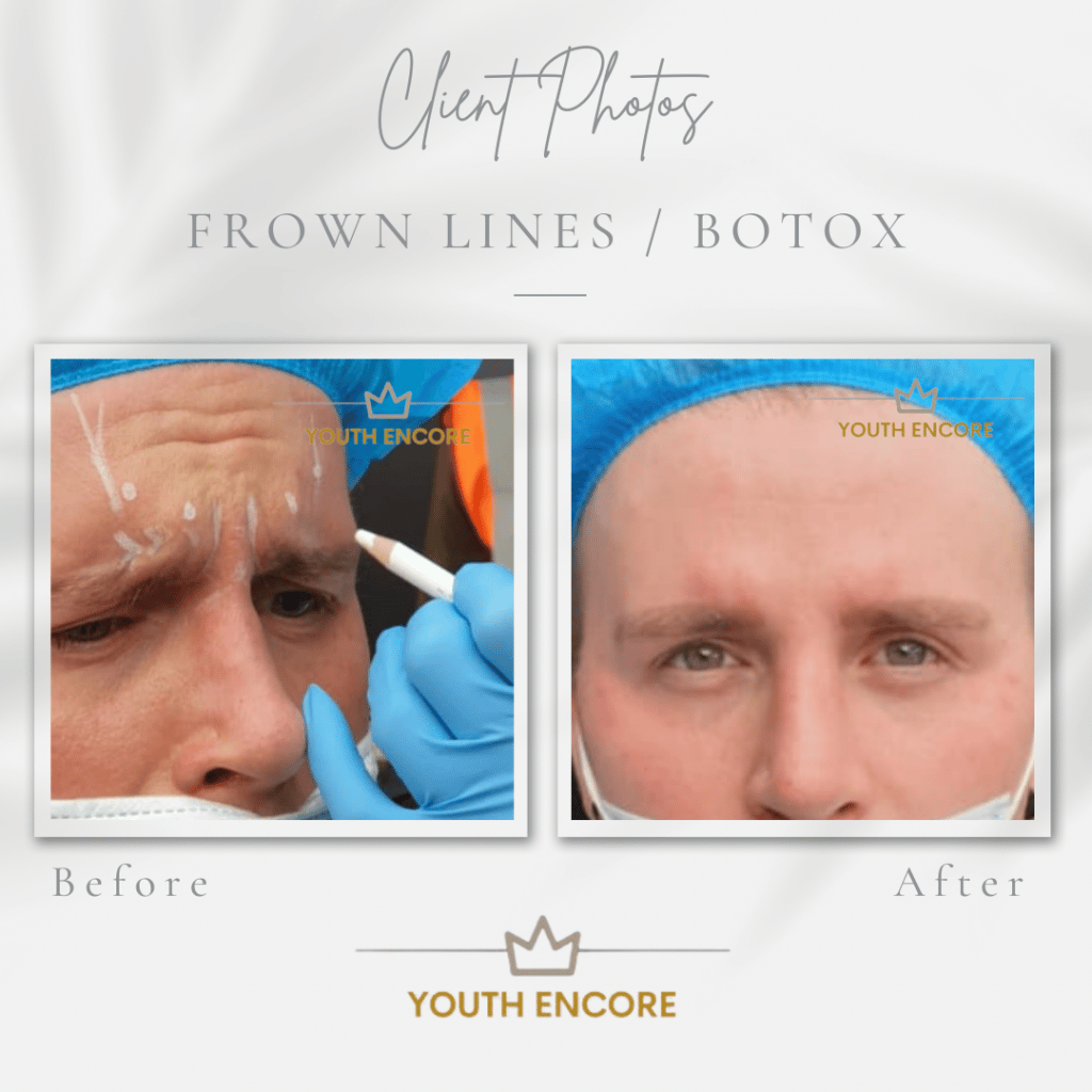 before and after upper face botox
