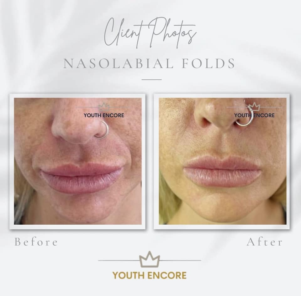 Nasolabial folds - before and after
