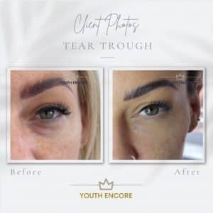 before and after tear trough treatment 3