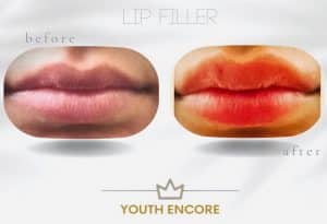 before and after lip fillers