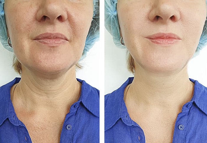 neck lift procedure