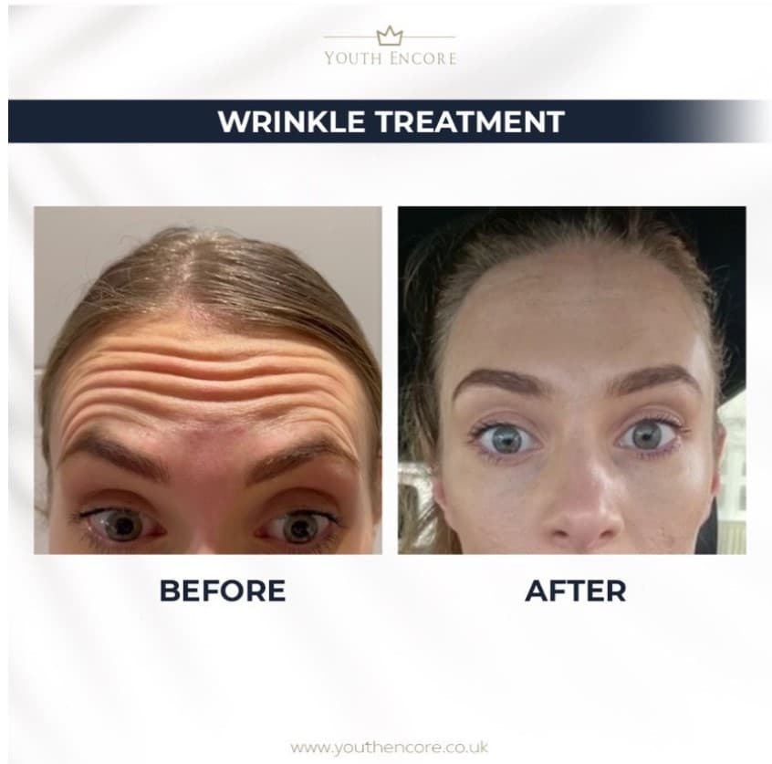 before and after upper face botox